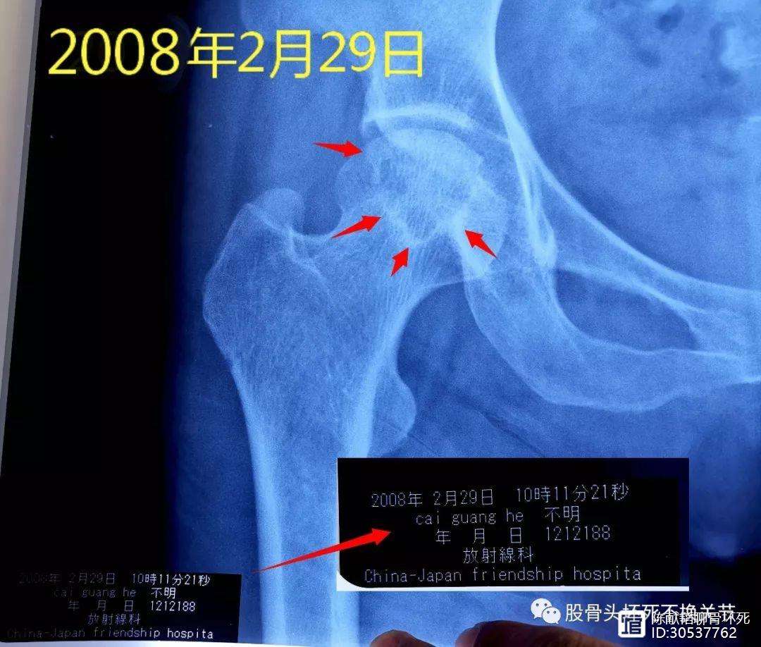 株洲人工骨头医保报销多少(人工骨头医保报销多少比例)